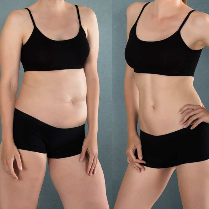 Cryolipolysis avant apres